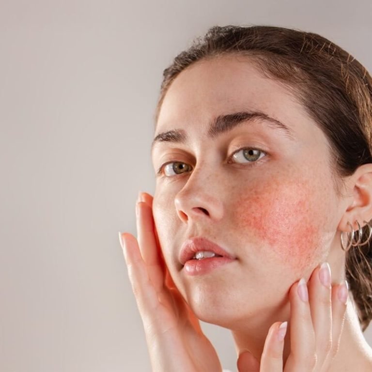 Rosacea-Biozone-01 Large