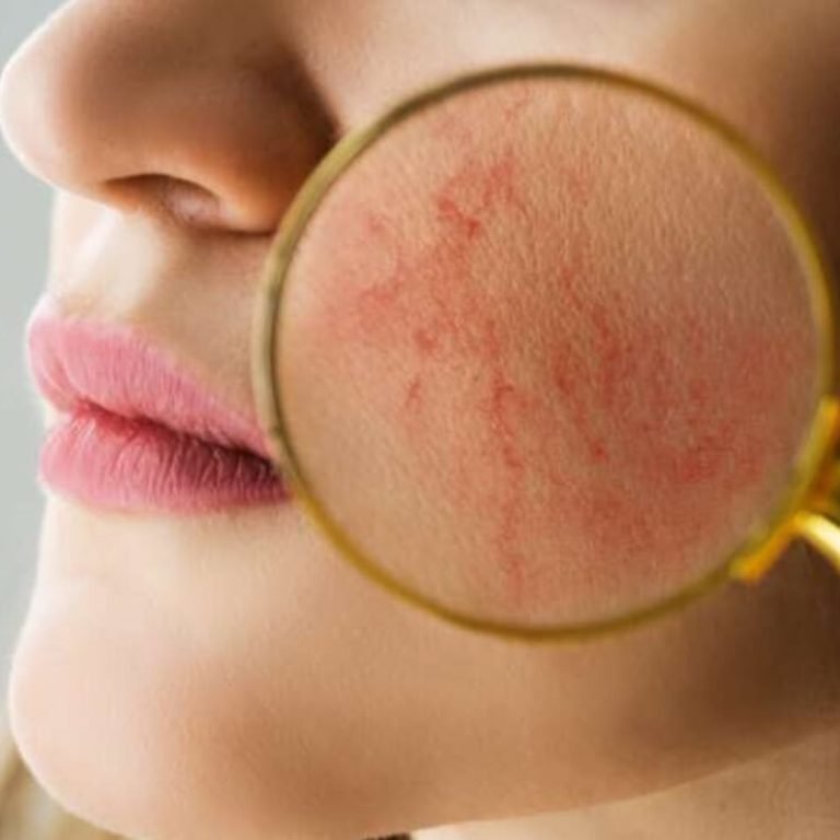 Telangiectasia-Facial-Biozone-01 Large
